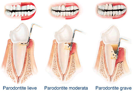 Risultato immagini per parodontologia foto